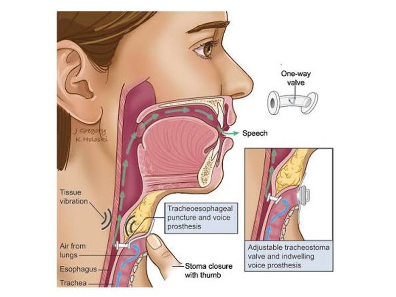 Laryngeal (Voice Box) Cancer Surgery in Ahmedabad
