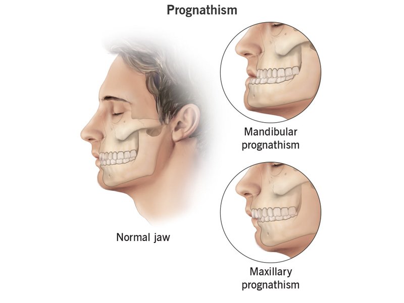 Maxillary & Mandibular Tumor Surgery in Ahmedabad