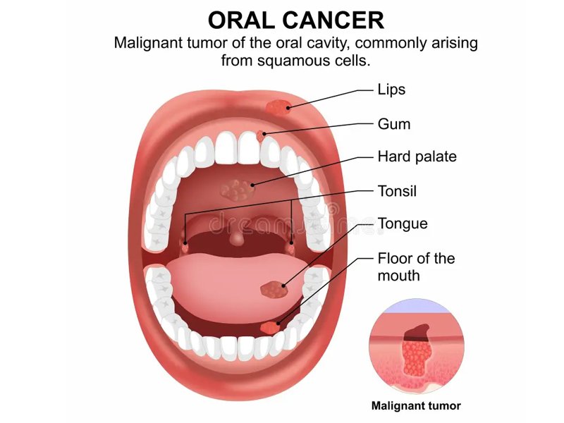 Tongue Cancer Treatment in Ahmedabad
