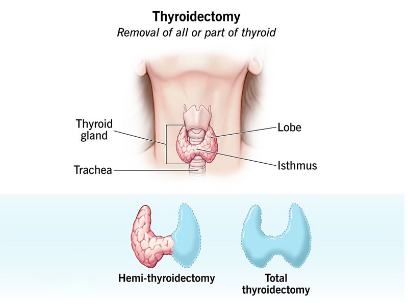 Thyroid Cancer Surgery in Ahmedabad