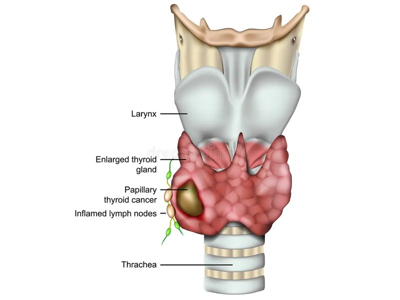 Thyroid Nodule Evaluation in Ahmedabad
